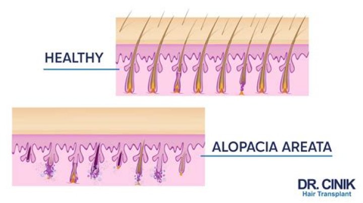Cynthia Erivo and Her Battle with Alopecia Areata: A Comprehensive Guide