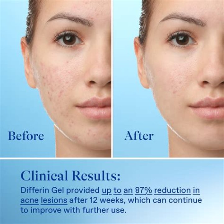 Differin Before and After: A Comprehensive Guide to Transforming Your Skin