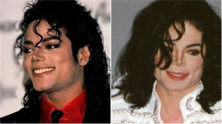 Michael Jackson Disease: Unveiling the Truth Behind the Icon's Health Struggles