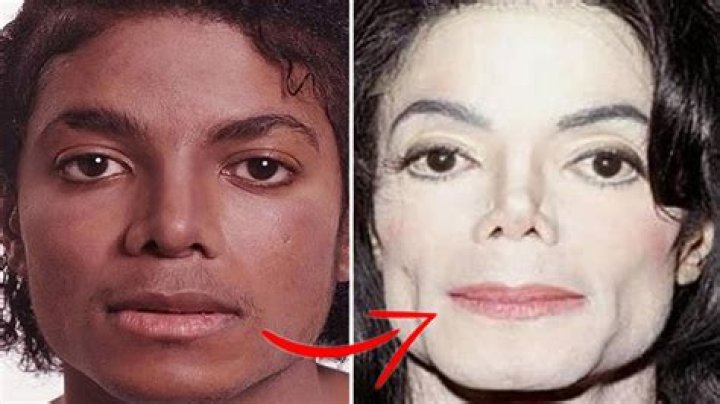 Michael Jackson Skin Condition: The Truth Behind His Transformation